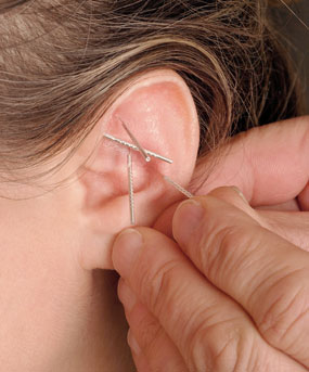 Auricular Therapy
