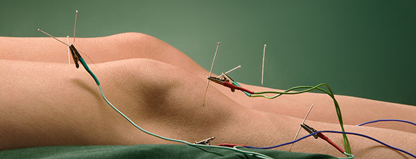 Acupuncture with Electrical Stimulation